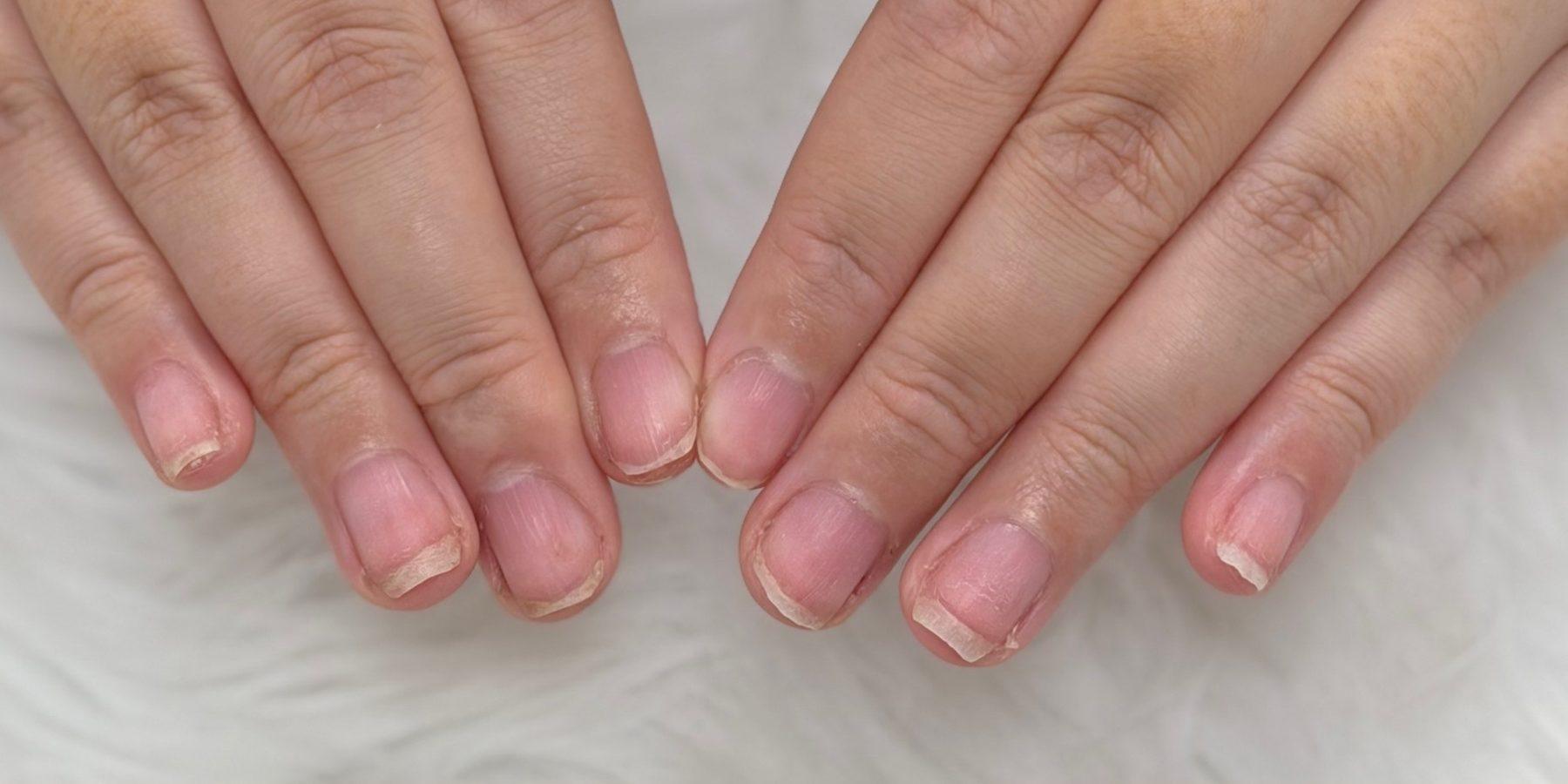 施術前の深爪の状態